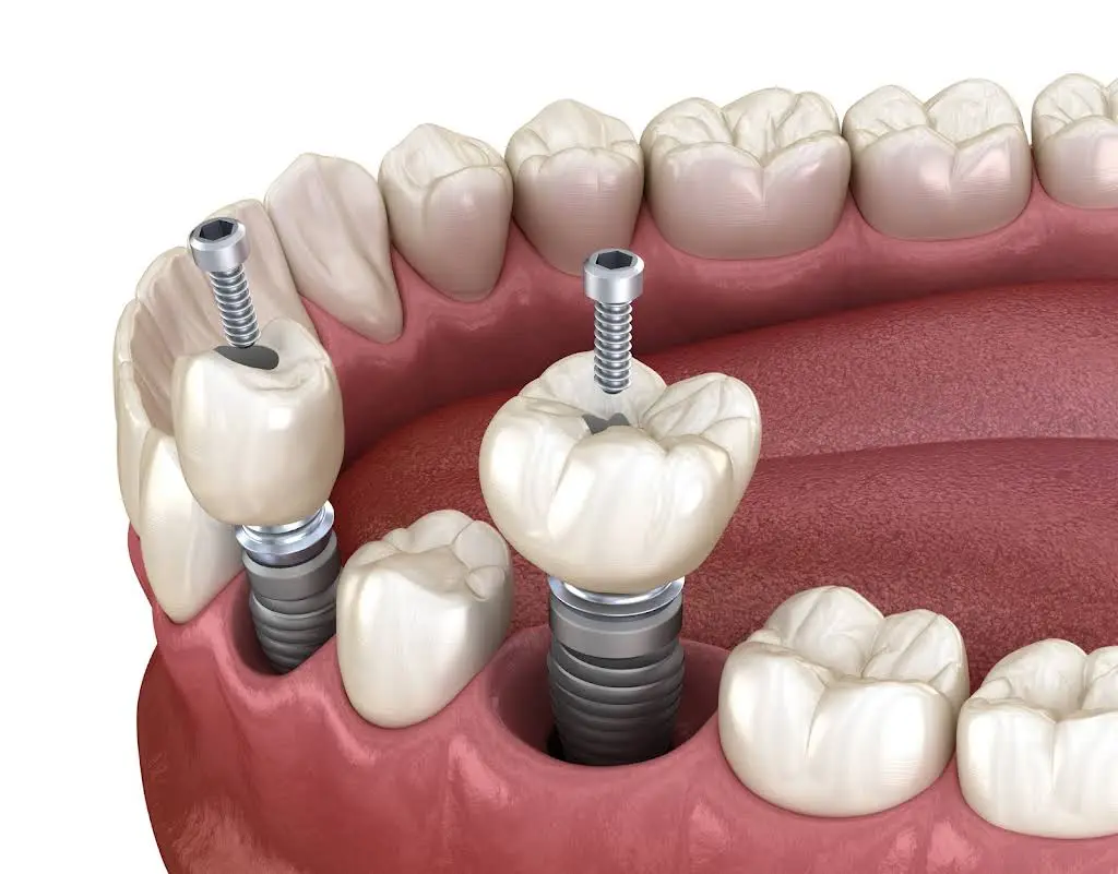 South Central Dental Implants
