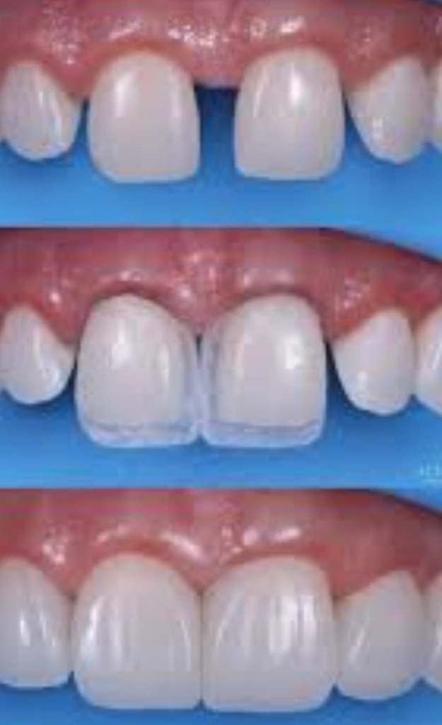 Economica Dental Dentauras y Extracciones