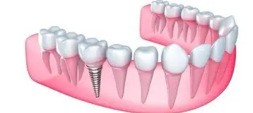 Dr Naser Sharifi Implant Dentistry