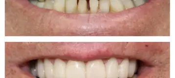 NÜVA Smile