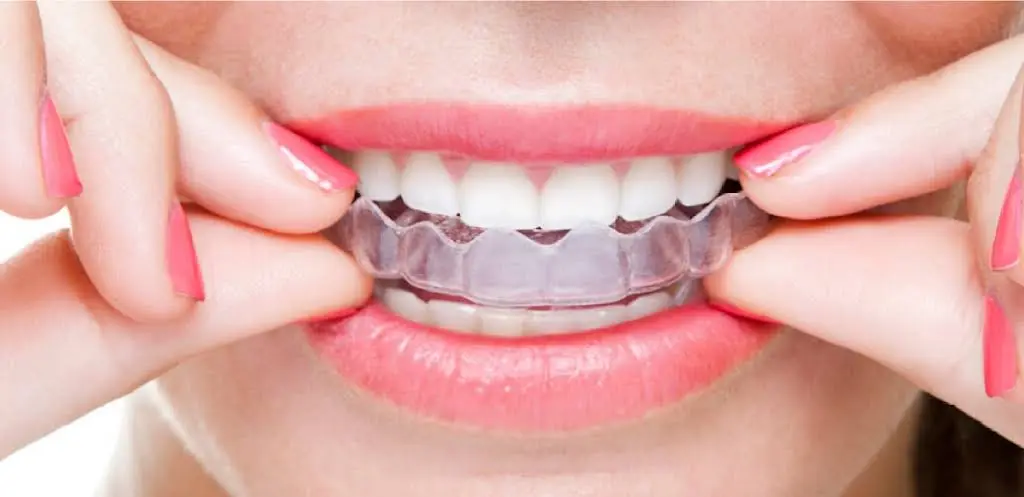Diamond Braces