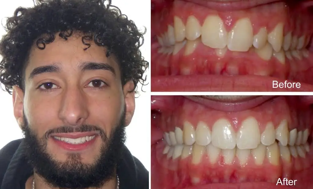 Diamond Braces