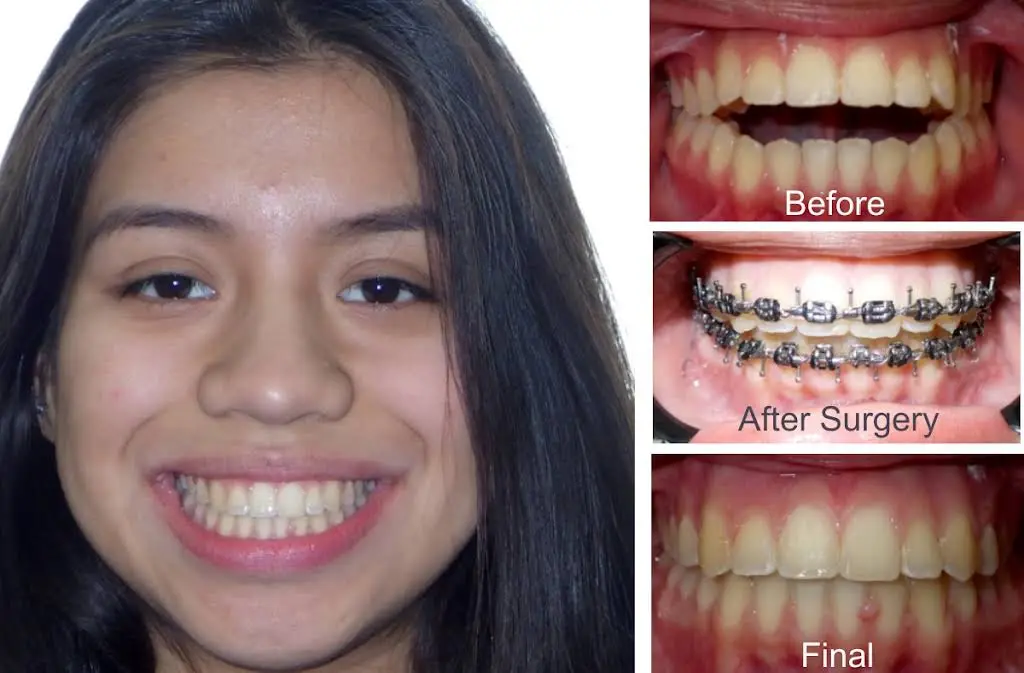 Diamond Braces