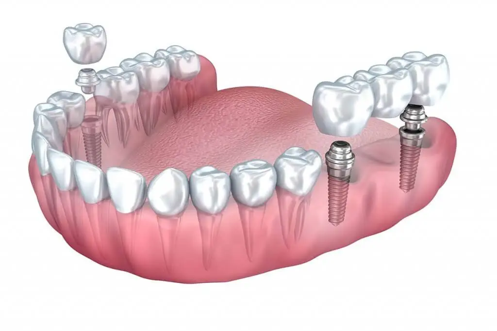 PureDent Plainview: Implant & Cosmetic Dentistry