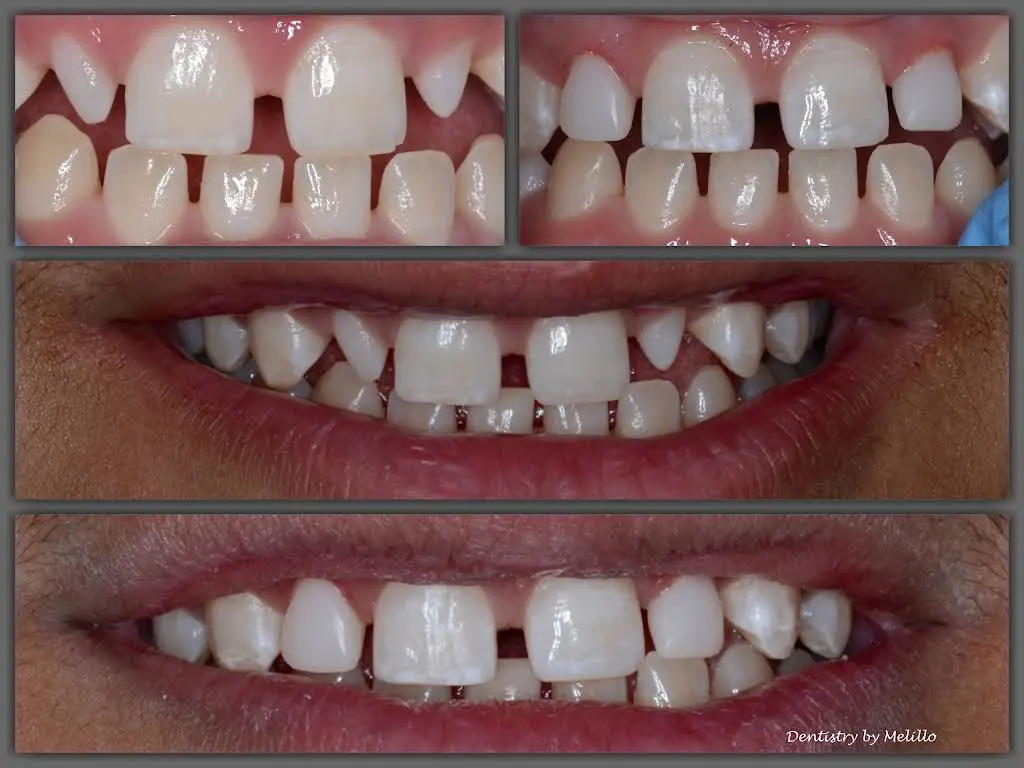 Melillo Dental Associates