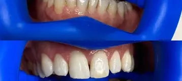 Luxe Teeth Whitening CT